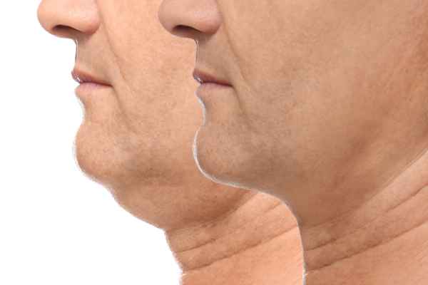 HIFU - Breakthrough in Anti - ageing 2 hifu results Walsall