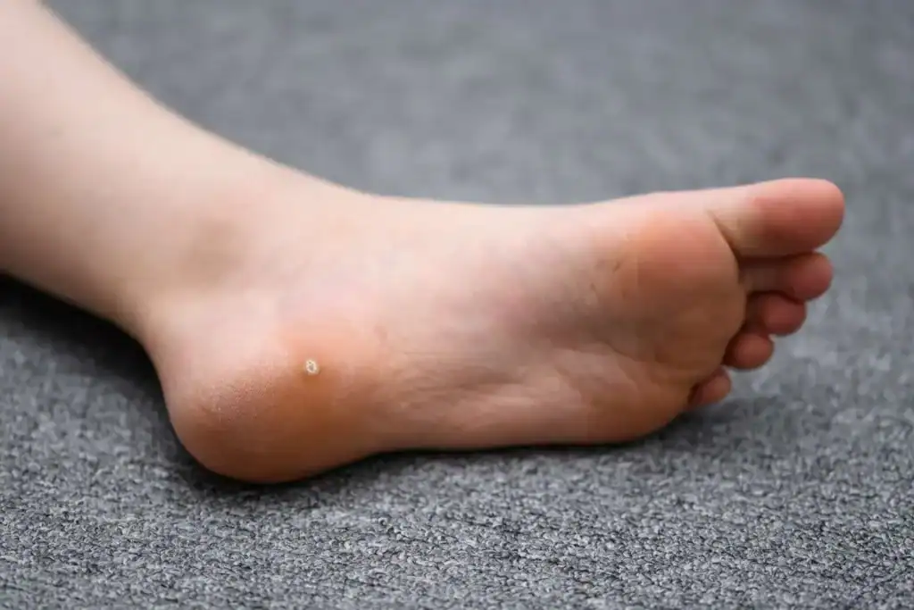 Cryotherapy For Warts And Also Verrucas 2 Image of verruca on the bottom of the foot that able to be treated with Cryotherapy Walsall