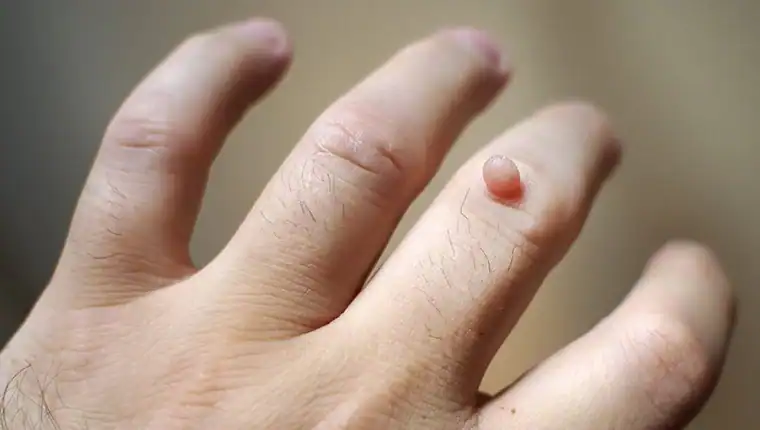 Cryotherapy For Warts And Also Verrucas 1 Image of blemish that Cryotherapy Walsall can remove with Lipo 360.
