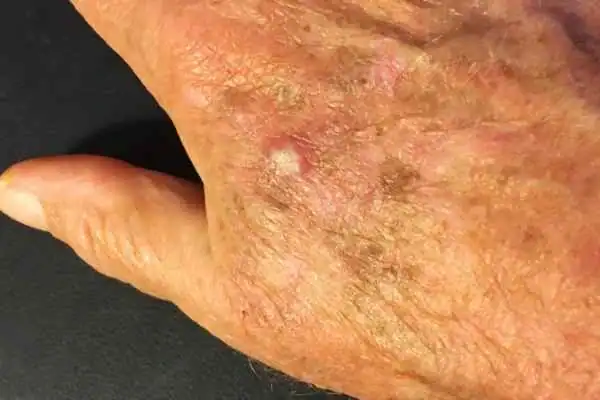 Cryopen For Actinic Keratoses 1 Image of Actinic keratoses Walsall on a person hand