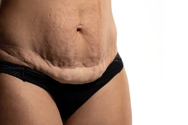 The Science of Skin Tightening 1 The science behind skin tightening Walsall picture of a woman's sagging skin on the stomach